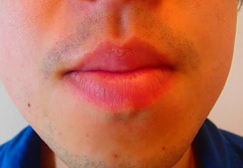 口周りのヒゲ脱毛効果before