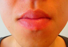 口周りのヒゲ脱毛効果after