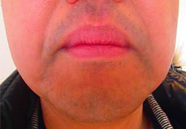 鼻下、アゴ周りののヒゲ脱毛効果before