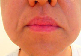 鼻下、アゴ周りののヒゲ脱毛効果after