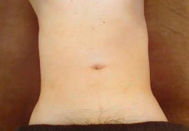 お腹周りの脱毛効果after