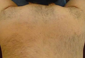 背中周りの脱毛効果before