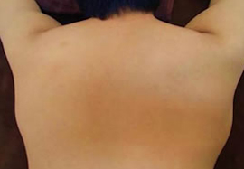 背中周りの脱毛効果after