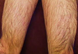 ひざ上(太もも)の脱毛効果before