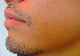 アゴ、ほほ、もみあげのデザインヒゲ脱毛の効果after