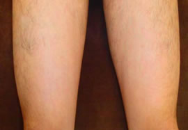 ひざ上(太もも)の脱毛効果after