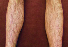 ひざ下の脱毛効果before