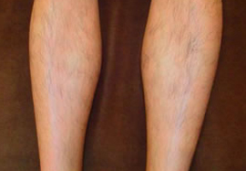 ひざ下の脱毛効果after