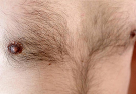 胸、乳輪周りの脱毛効果before