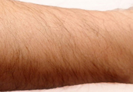 ひじ下の脱毛効果before