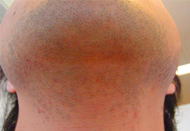 アゴ裏、首のヒゲ脱毛効果before