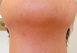 アゴ裏、首のヒゲ脱毛効果after