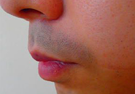 鼻下のヒゲ脱毛効果before